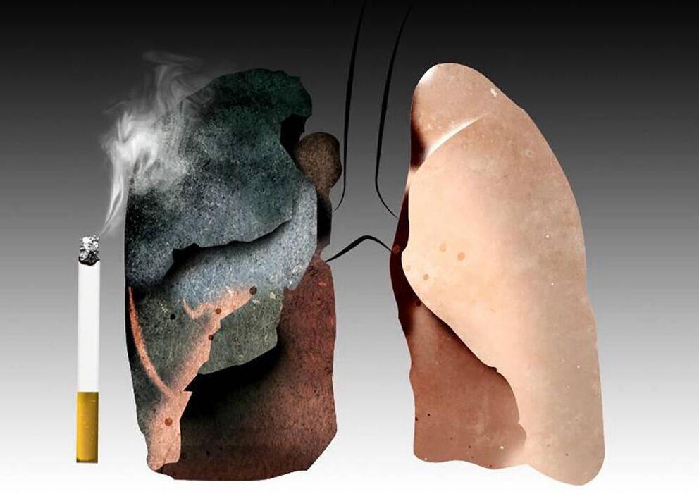 poumons d'un fumeur